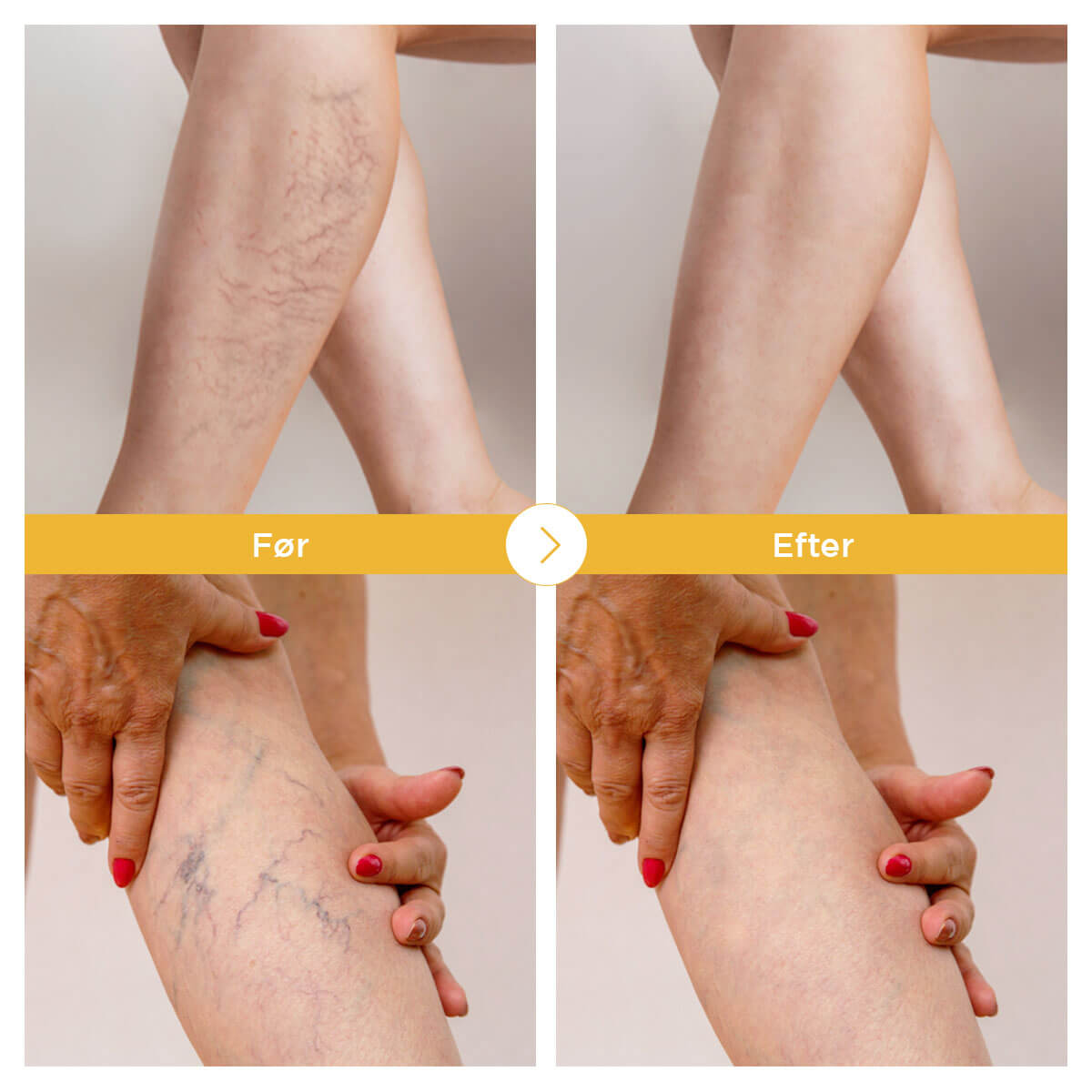 [50% FRA] Stunor™ Opvarmet Benmassageapparat