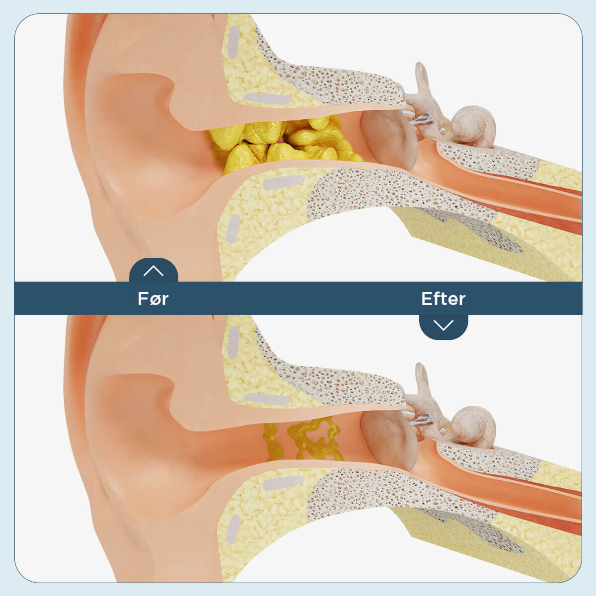 [50% FRA] - Stunor™ - Apparat Til Fjernelse Af Ørevoks