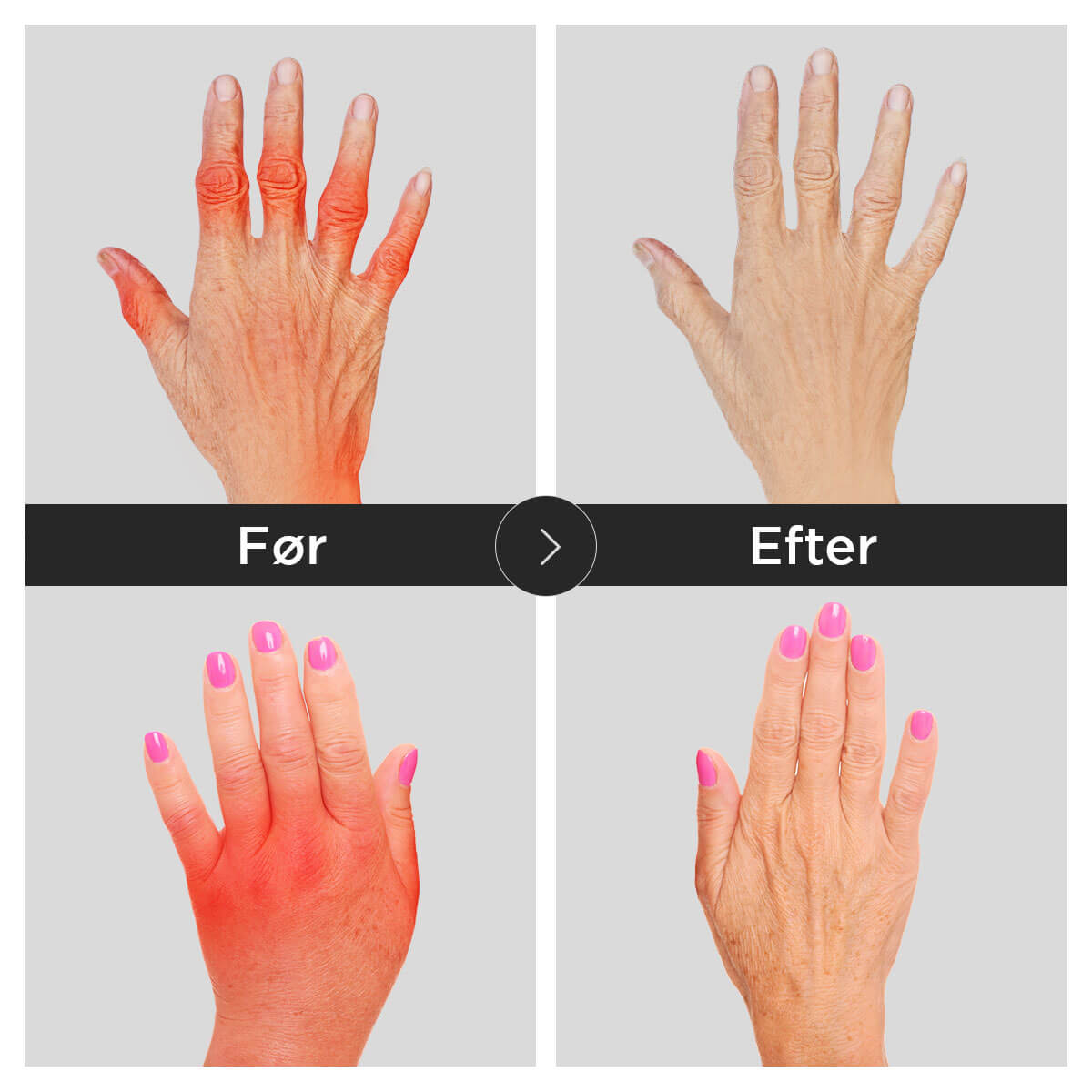 [50% OFF] Dr.Karpaltunnel ™ Smertelindring kobber kompressionshandsker