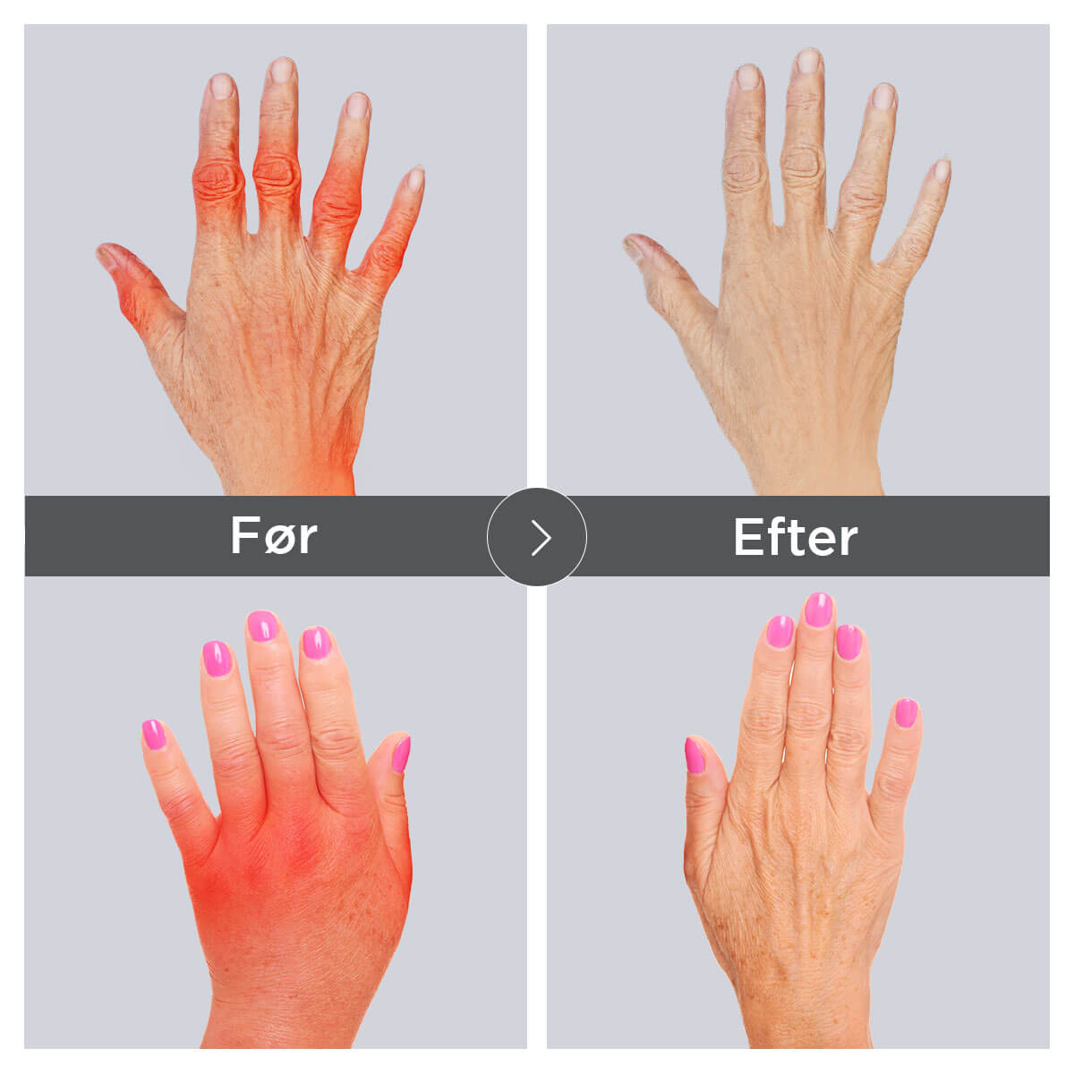 [50% OFF] Dr.Arthritis™ kompressionshandsker til smertelindring